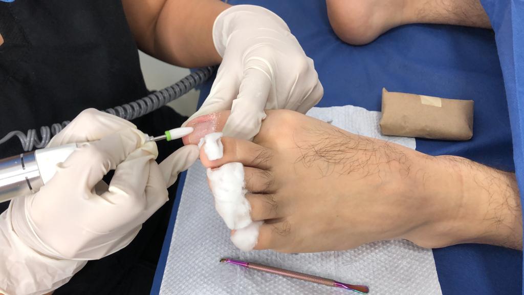 thumbnail_Tratamiento podología uñas